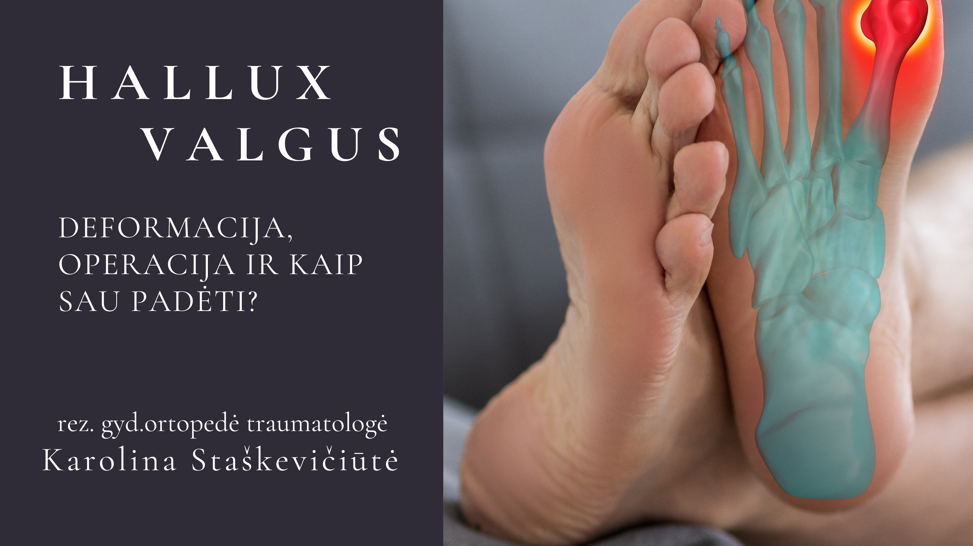 Hallux Valgus pėdos deformacija. Kas, kaip ir kodėl?