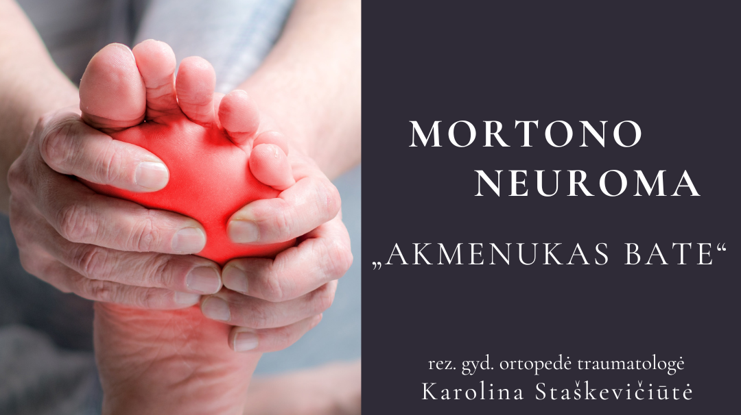 Mortono neuroma - „akmenukas bate“