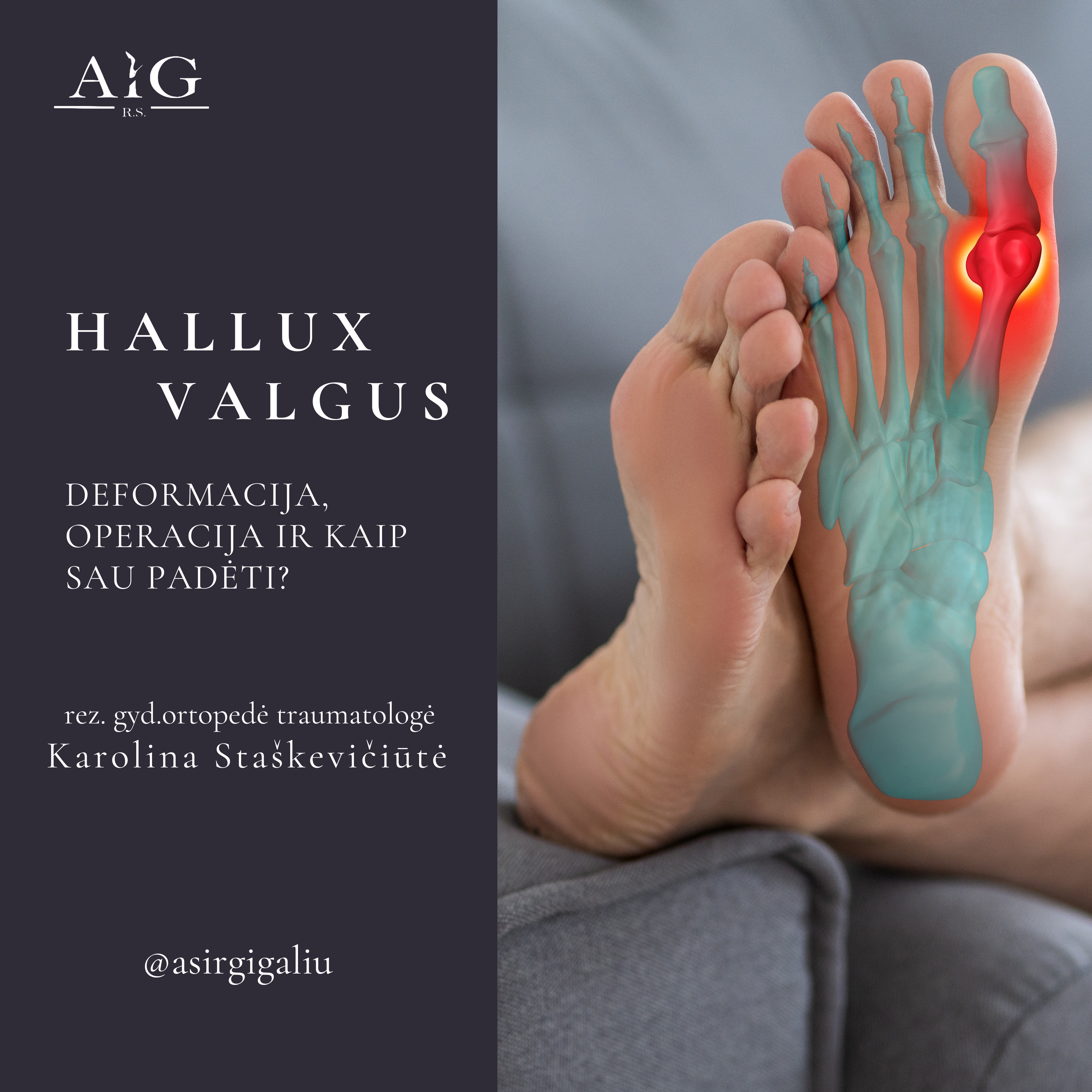 Hallux Valgus pėdos deformacija. Kas, kaip ir kodėl?