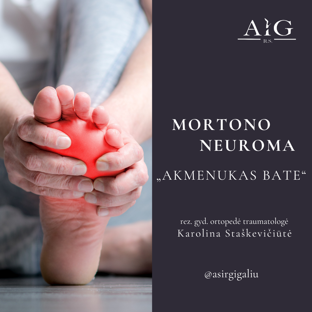 Mortono neuroma - „akmenukas bate“
